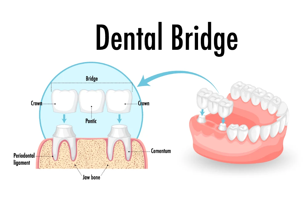 Bridges img